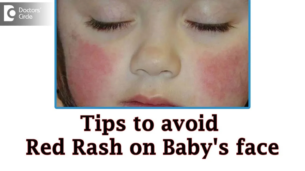 baby flushed cheeks fever